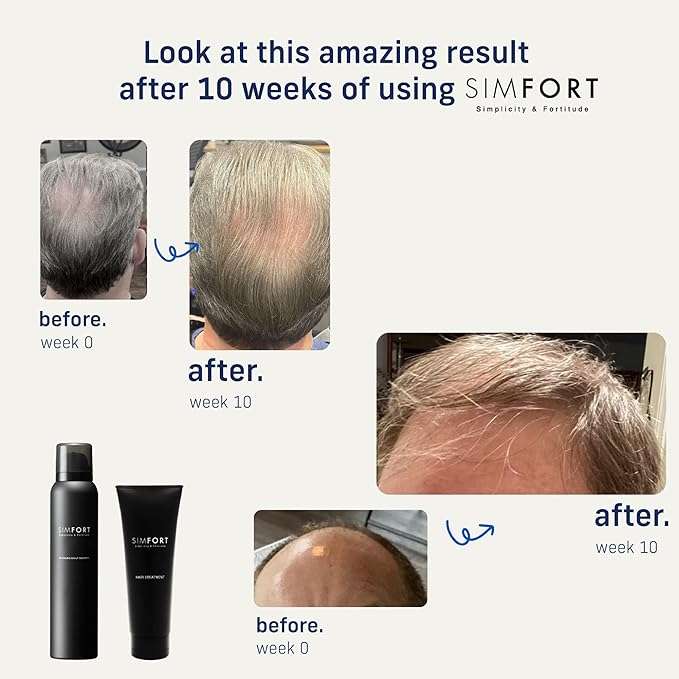 SIMFORT ile saç bakımında devrim yapmaya hazır mısınız? 💫 Kepek sorununa veda edin, saç kalitesini arttırın! Ücretsiz örnek için profildeki linki tıklayın
